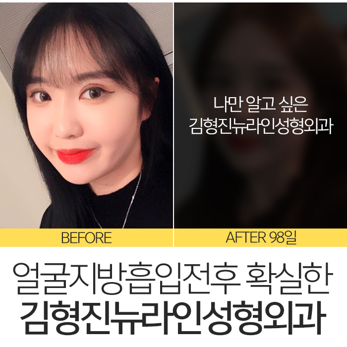 얼굴지방흡입전후 제대로 보려면 관련 이미지 3