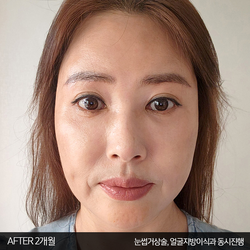 미니하안검수술방법 궁금하시죠? 관련 이미지 3