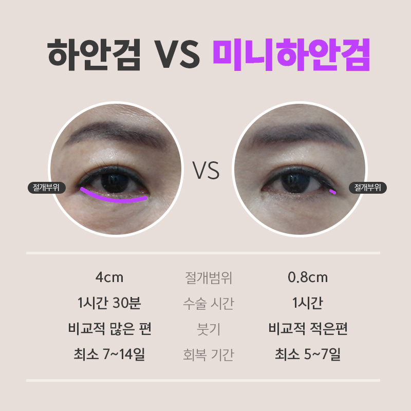 Looking for a Clinic to Reverse Sagging Without Mini Lower Blepharoplasty Scars? image 4