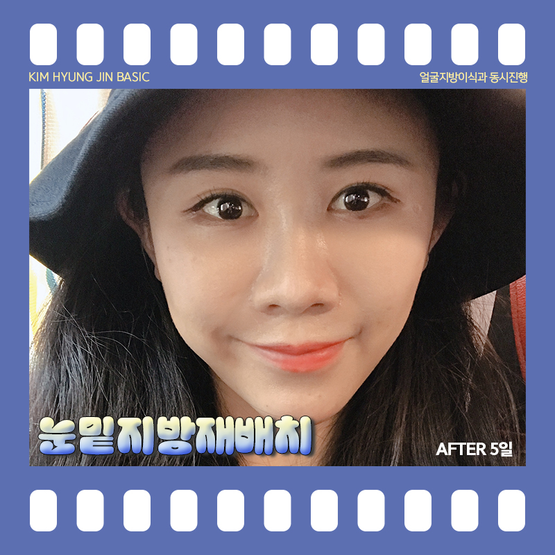 눈밑지방재배치통증! 걱정 안해도 되는 이유 관련 이미지 3