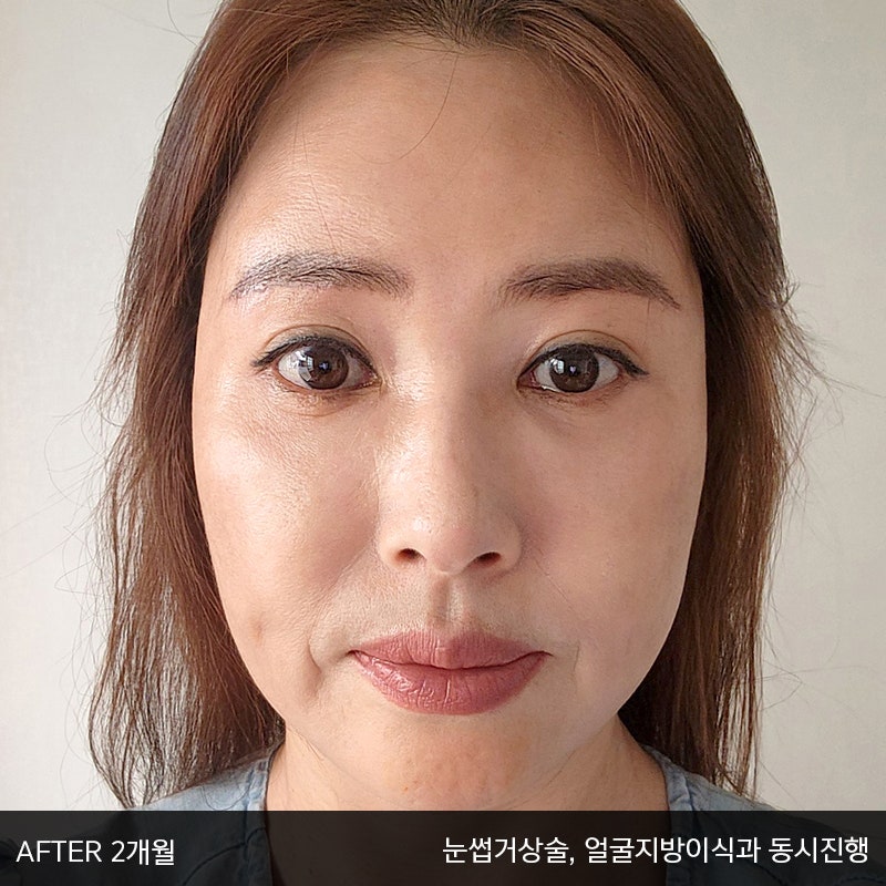 중년눈밑지방수술 아직 모르신다면 관련 이미지 7