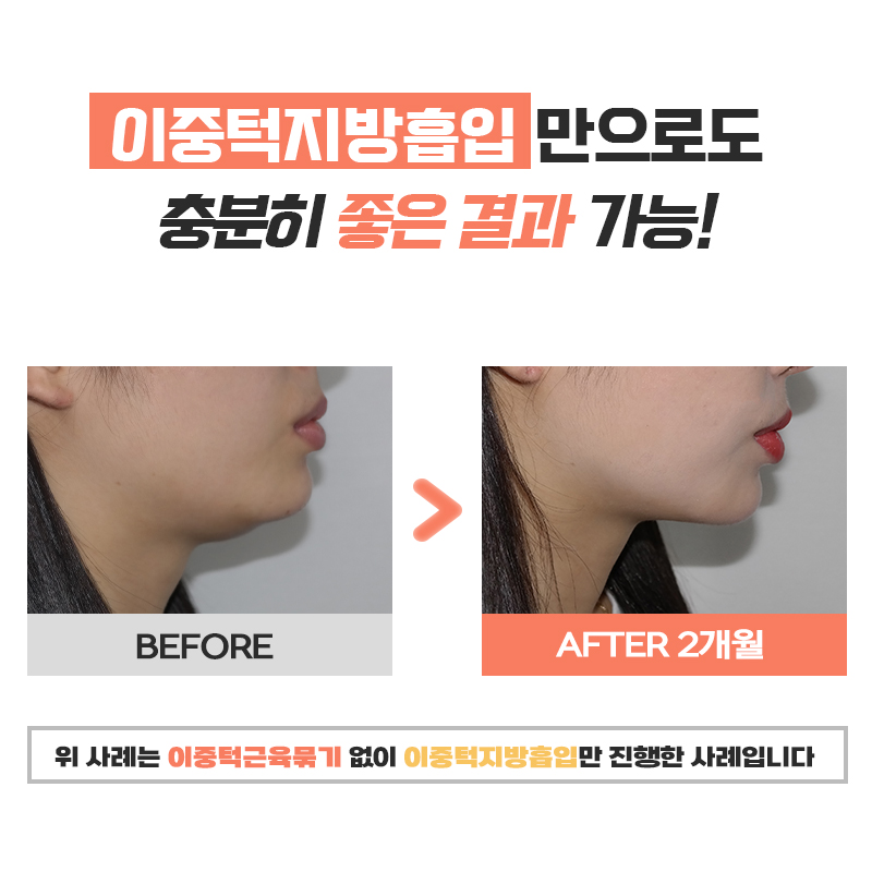 턱살 삭제하고 싶어서 받은 이중턱지흡 관련 이미지 6