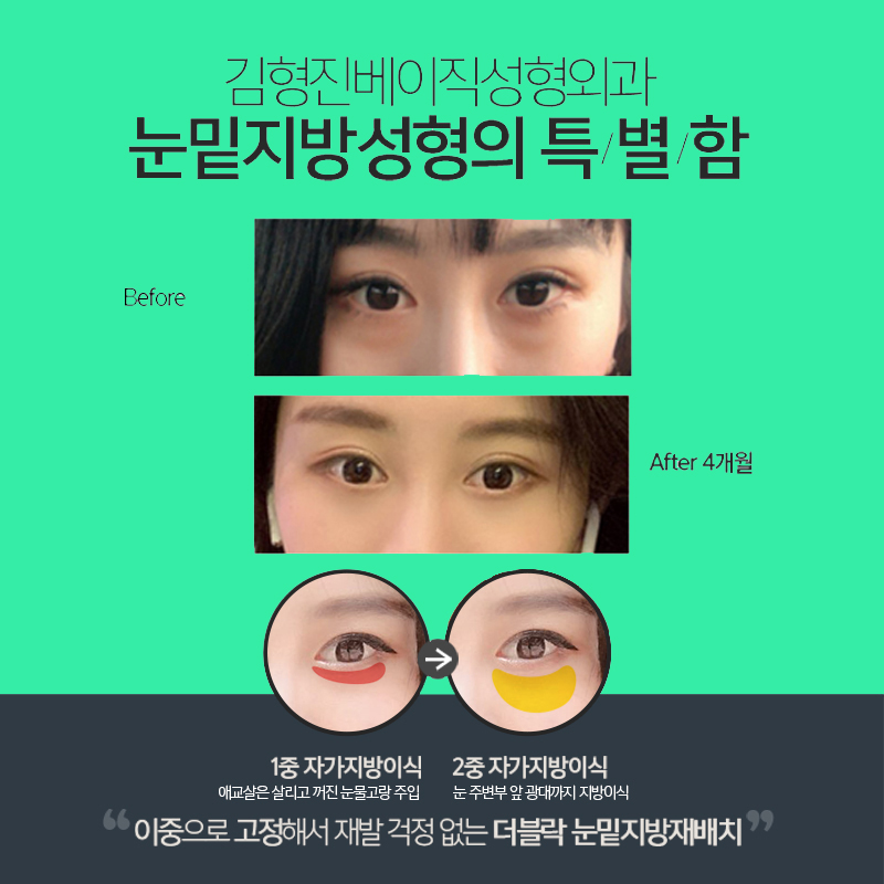 압구정눈밑지방재배치 재발없이 오래도록 유지하는 비결 관련 이미지 5