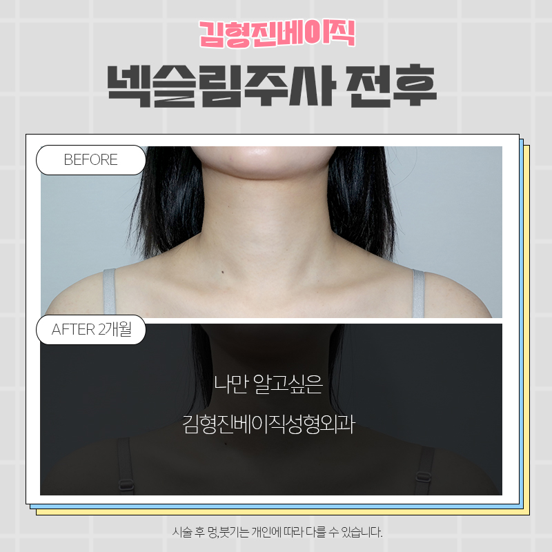 넥슬림보톡스전후 궁금하신분!? 관련 이미지 2