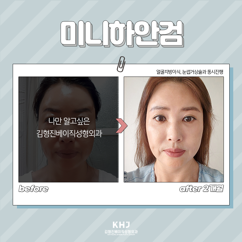 미니하안검수술 어떤 효과가 있냐면요 관련 이미지 5