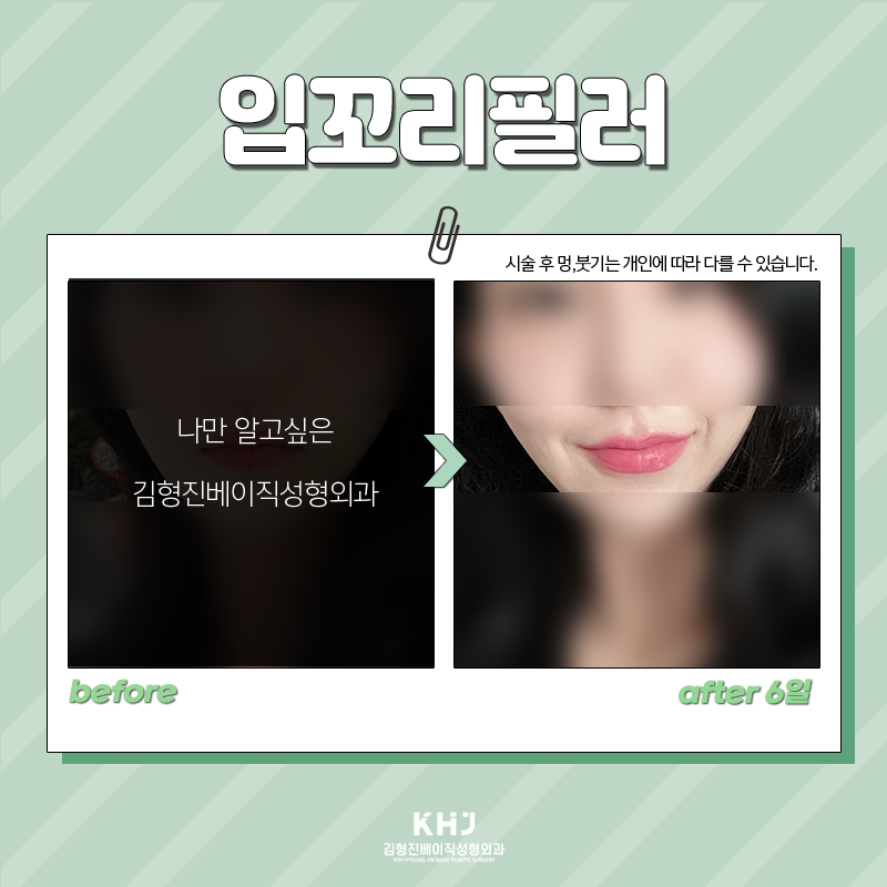 입꼬리필러모양 섬세하게 잡아줄 수 있는 곳에서 하셔야죠 관련 이미지 6