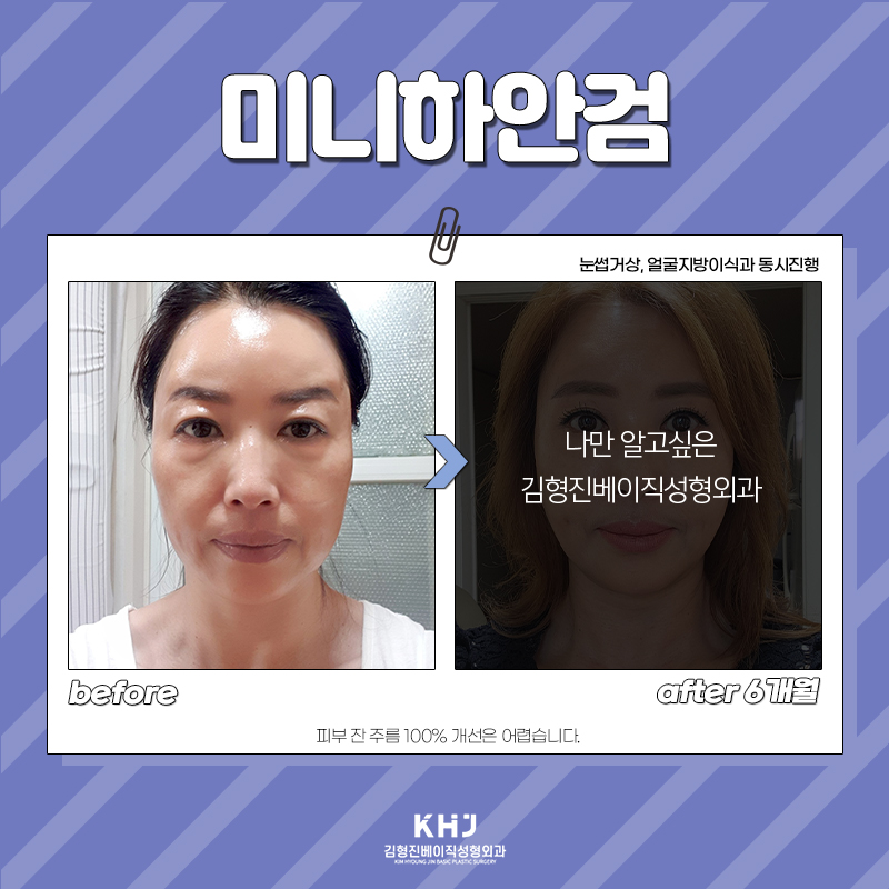 중년눈밑성형 전에 무조건 이걸 알고 가셔야 합니다! 관련 이미지 6