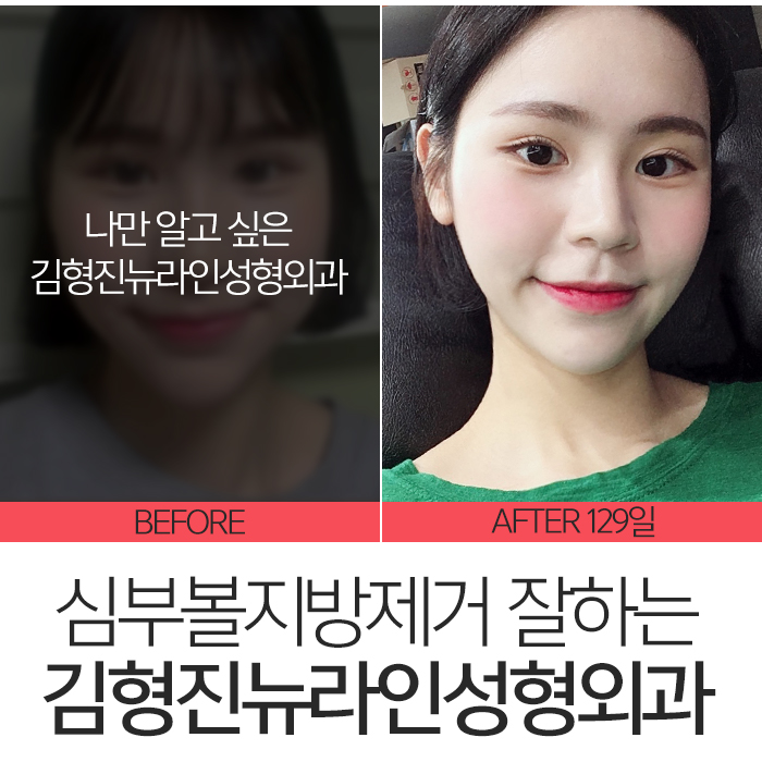 심부볼가격 아직도 싼 곳만 찾아요? 관련 이미지 8