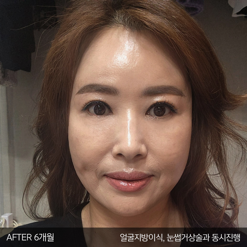 미니하안검수술은 김형진베이직이죠 관련 이미지 6