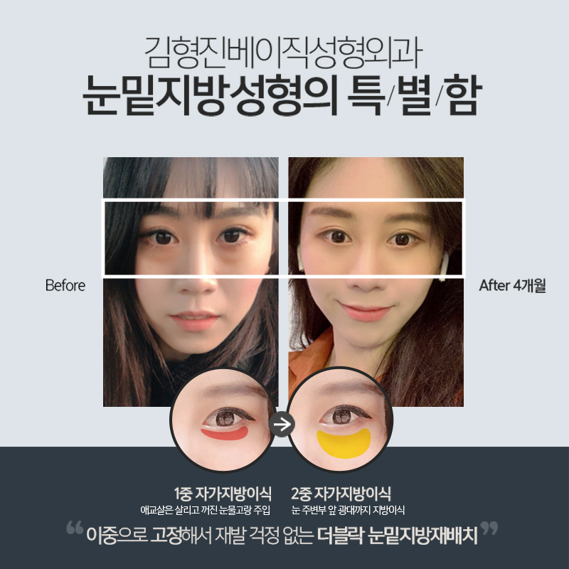 눈밑지방재배치재수술 걱정마세요 관련 이미지 2