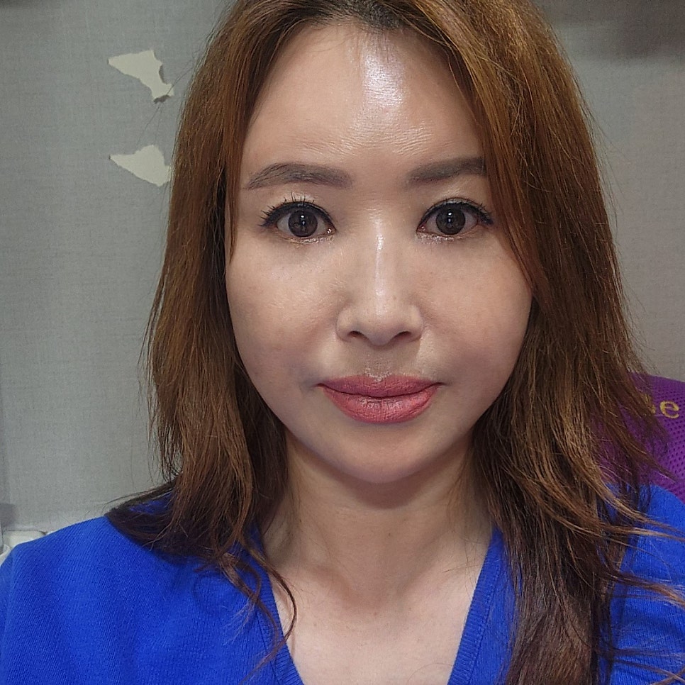 Middle-Aged Under-Eye Surgery Review: I Look Younger After Mini Lower Blepharoplasty image 2