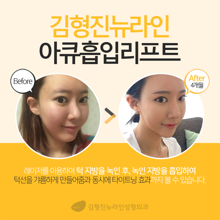 이중턱지방흡입부작용 걱정 없는데 관련 이미지 3