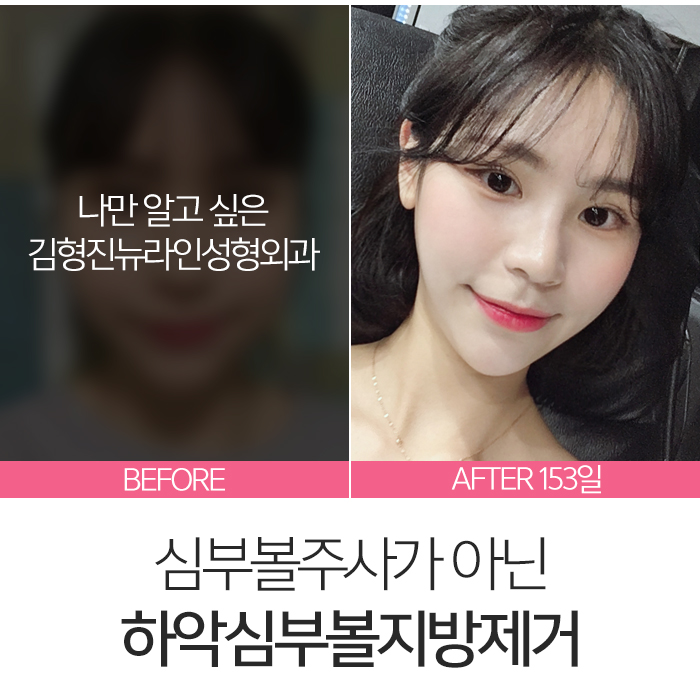 심부볼주사 이걸론 절대 못 빼요 관련 이미지 2