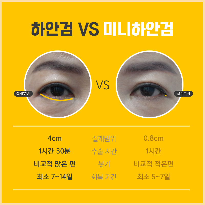 미니하안검전후 비교해보고 결정하세요! 관련 이미지 4