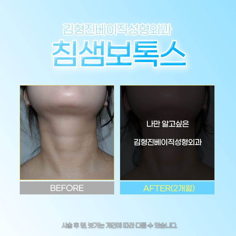 침샘비대증시술 아무 데서나 받으면 안되는 이유 관련 이미지 5