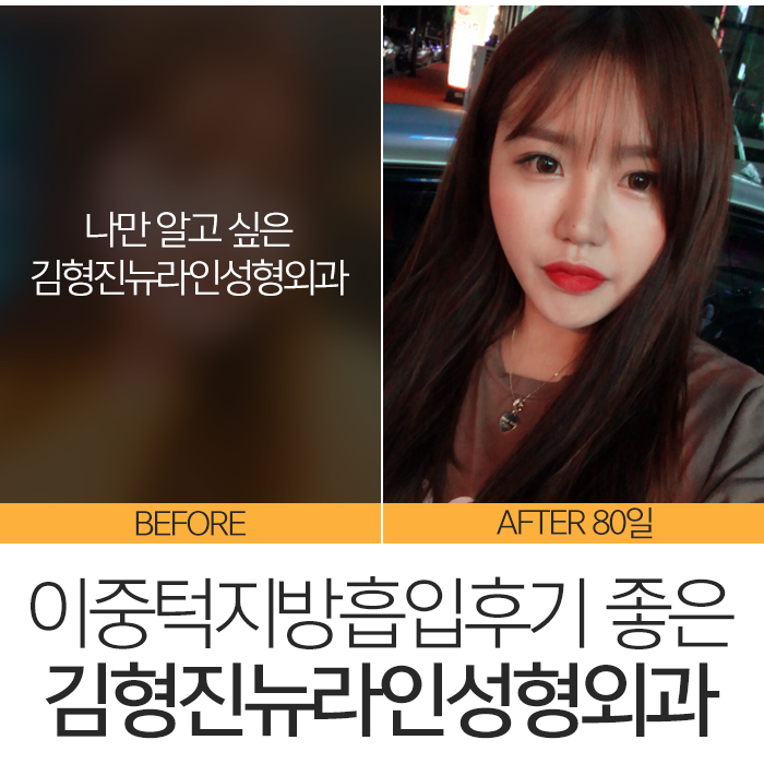 이중턱지방흡입후기 솔직하게 관련 이미지 7