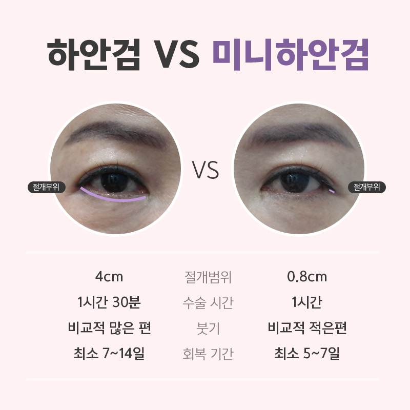 미니하안검흉터 걱정하지마세요! 관련 이미지 4
