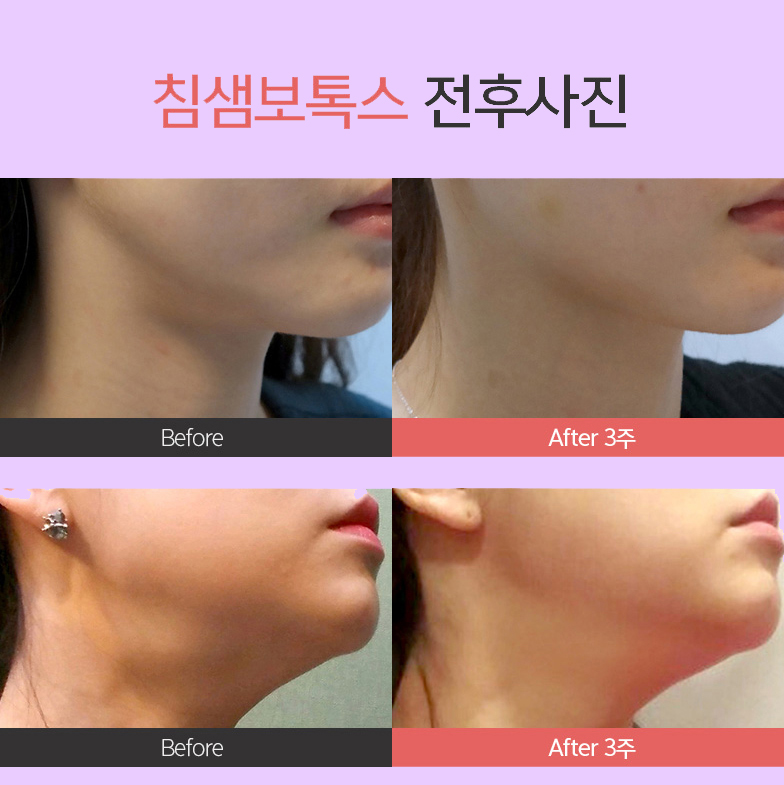 서울침샘보톡스추천 할만한 곳 알아보는 중이라면 관련 이미지 6