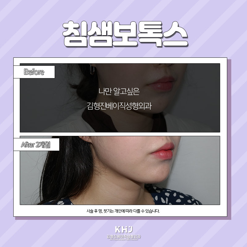 침샘보톡스효과 이렇게나 좋다구요! 관련 이미지 6