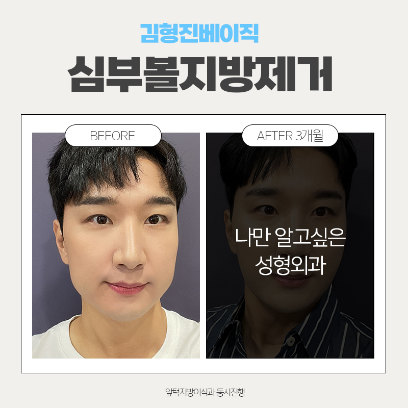 심부볼제거후기 이정도는 돼야죠 관련 이미지 4