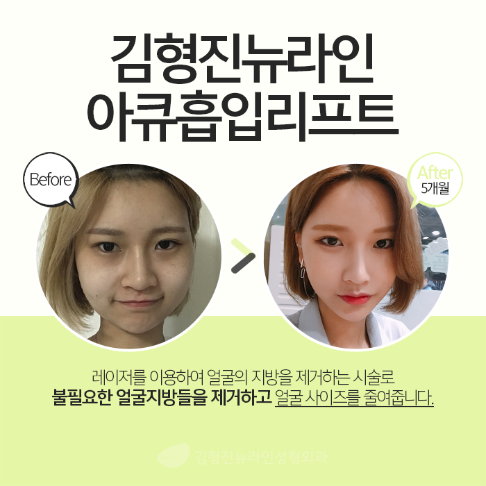 얼굴아큐스컬프 안 할 이유가 없죠 관련 이미지 3