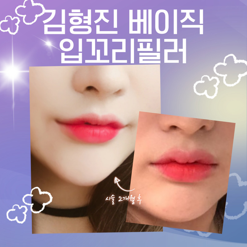 드디어 남자입꼬리필러도 잘하는 곳 찾았어요! 관련 이미지 4