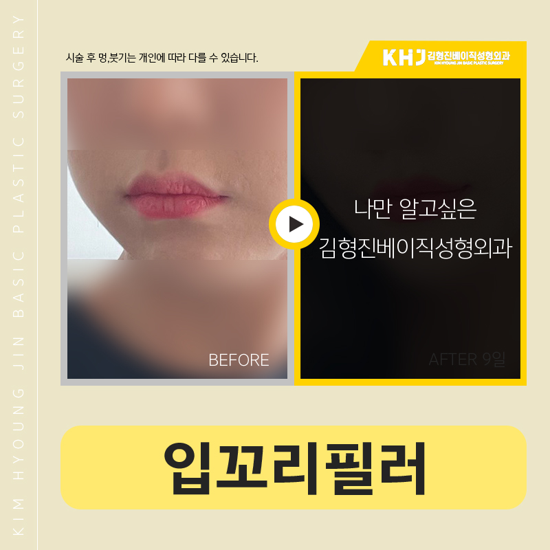 입꼬리필러전후 이보다 다를 수가 있나요? 관련 이미지 5