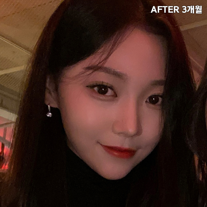심부볼제거수술을 왜 받냐구요? 관련 이미지 7