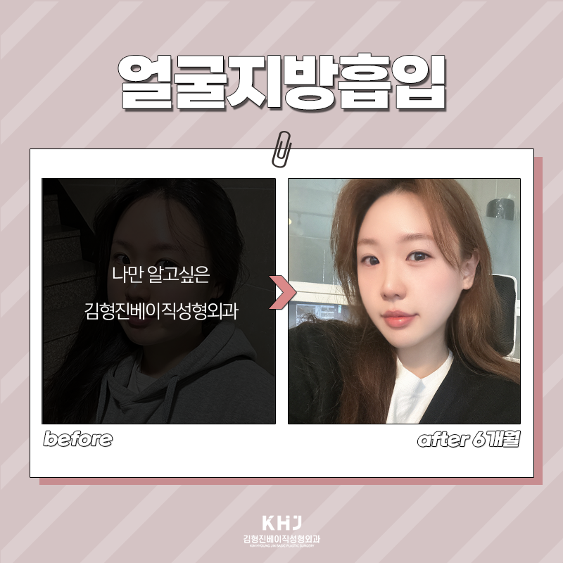 얼굴지방흡입전후 보고 가세요! 관련 이미지 5