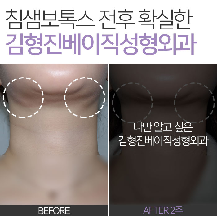 침샘보톡스전후 차이, 보이세요? 관련 이미지 7