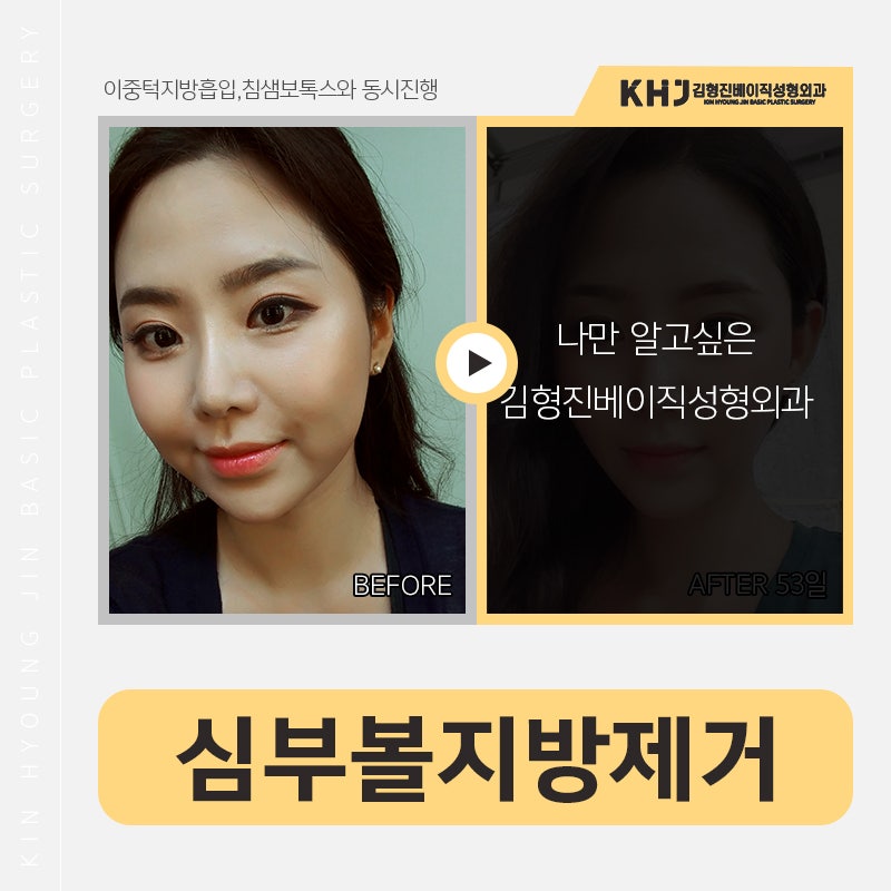 심부볼제거 부작용 걱정 왜 해요? 관련 이미지 5