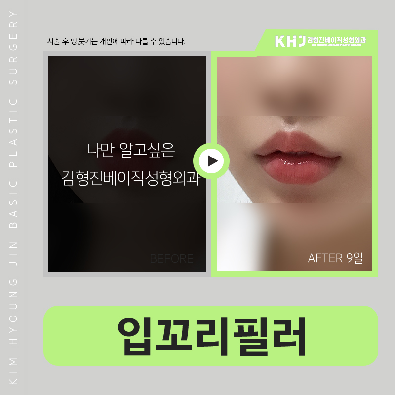 입꼬리시술 길게 고민 할 필요 없었어요 관련 이미지 6