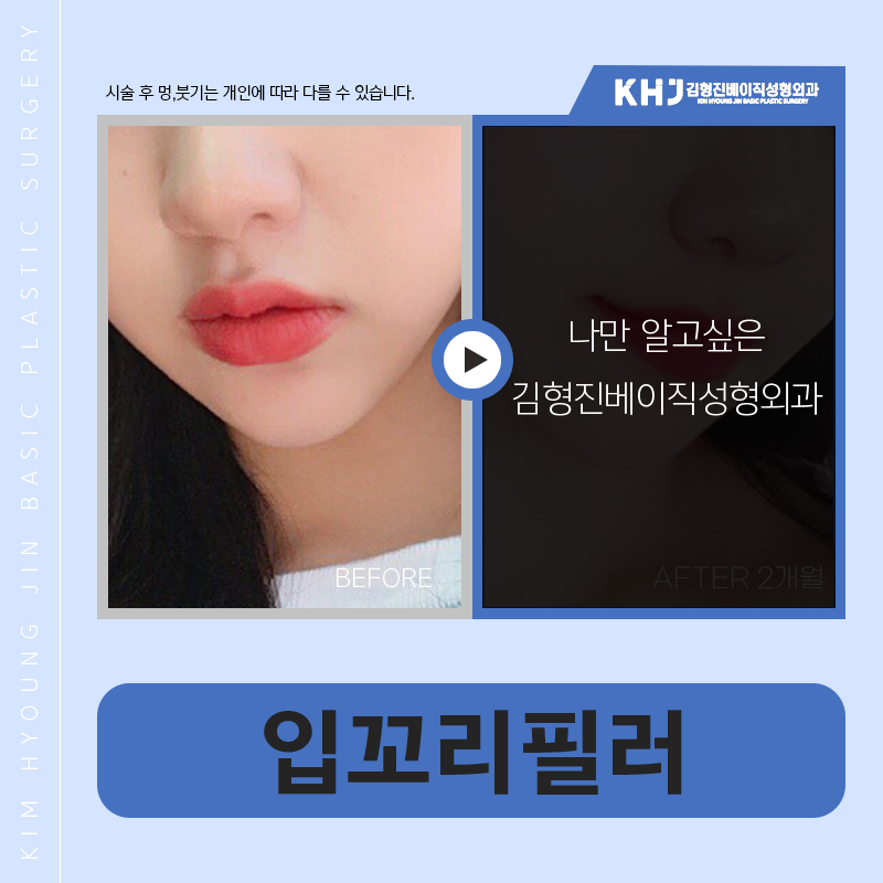 입꼬리필러잘하는곳은 다 이유가 있습니다 관련 이미지 5