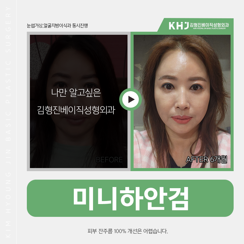 중년눈밑수술 김형진베이직에서 하셔야죠! 관련 이미지 3