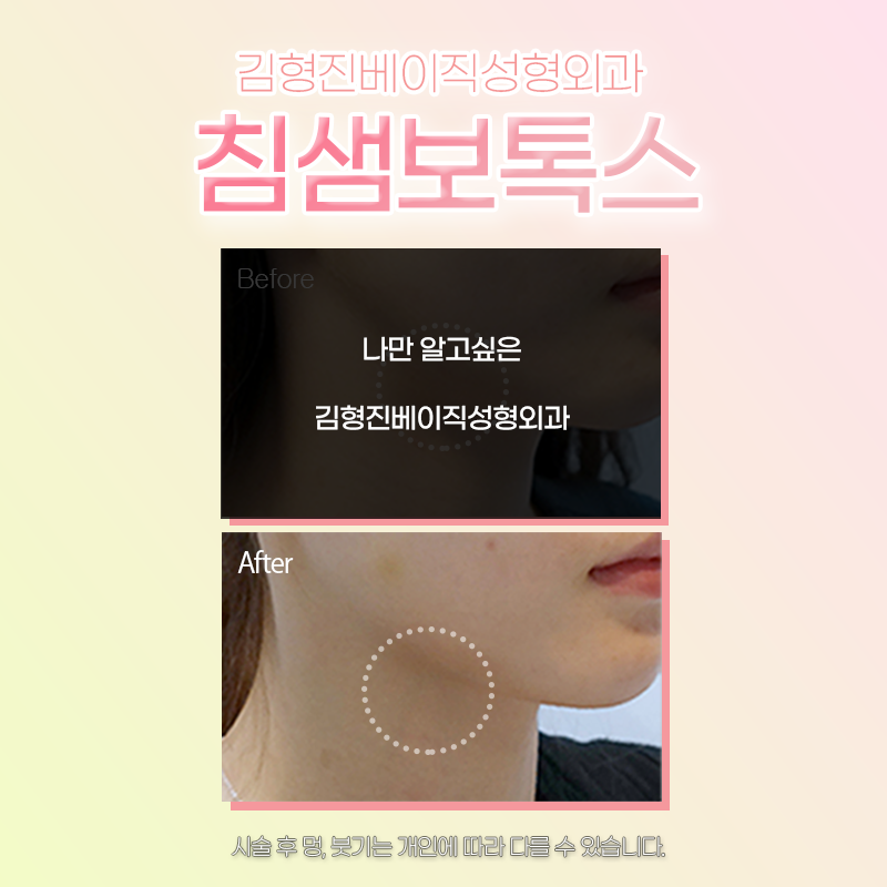 침샘보톡스효과 볼 수 있는 곳에서 하셔야죠 관련 이미지 6