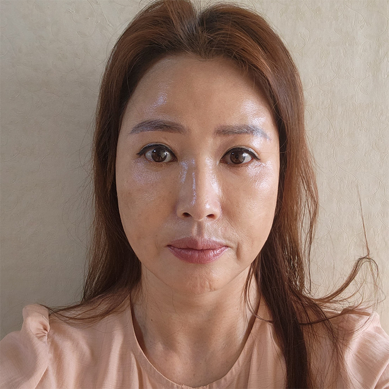 Still 고민 about under-eye surgery in middle age? image 1