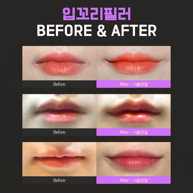 무표정도 환하게! 입꼬리필러시술로 인상 리셋했어요 관련 이미지 5