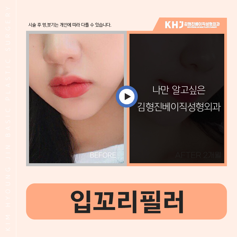 강남입꼬리필러추천 부드럽고 생기 있는 미소 만들기 관련 이미지 5