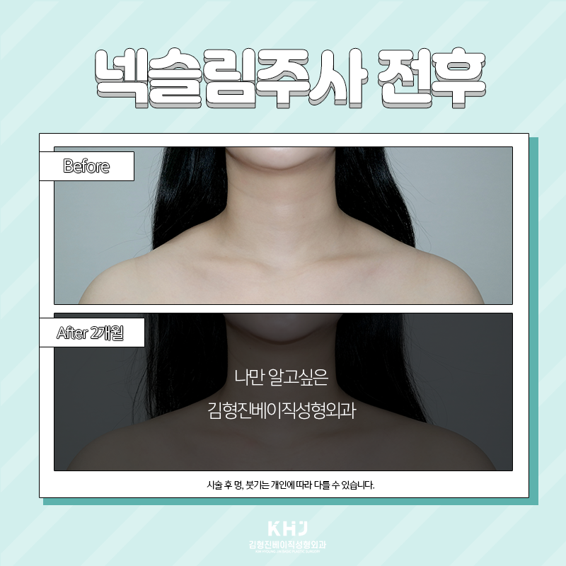 웨딩시술 뭐해야 할지 고민되셨다면? 관련 이미지 2