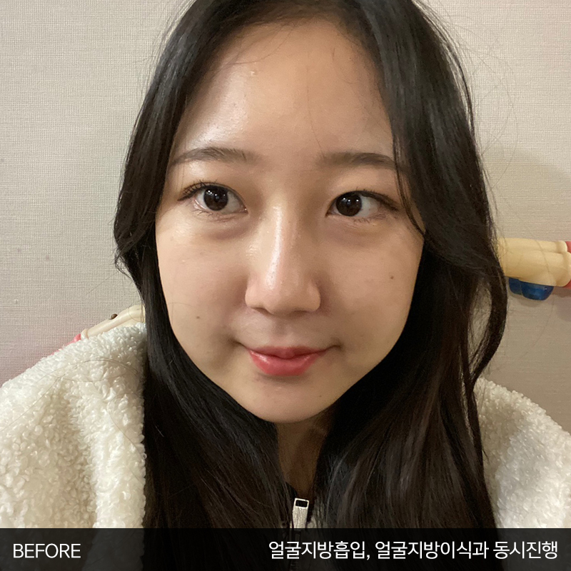 눈밑수술! 어떤건지 궁금하시죠? 관련 이미지 2