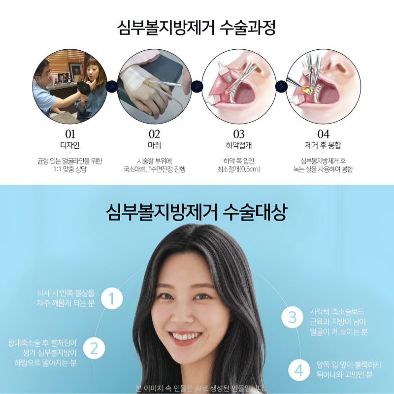 Cheek Fat Removal at a Place That Specializes in It image 6
