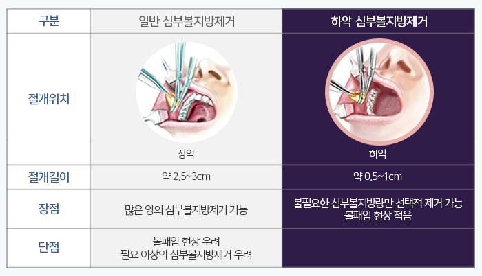 하악심부볼지방제거 볼패임을 잡다 관련 이미지 4