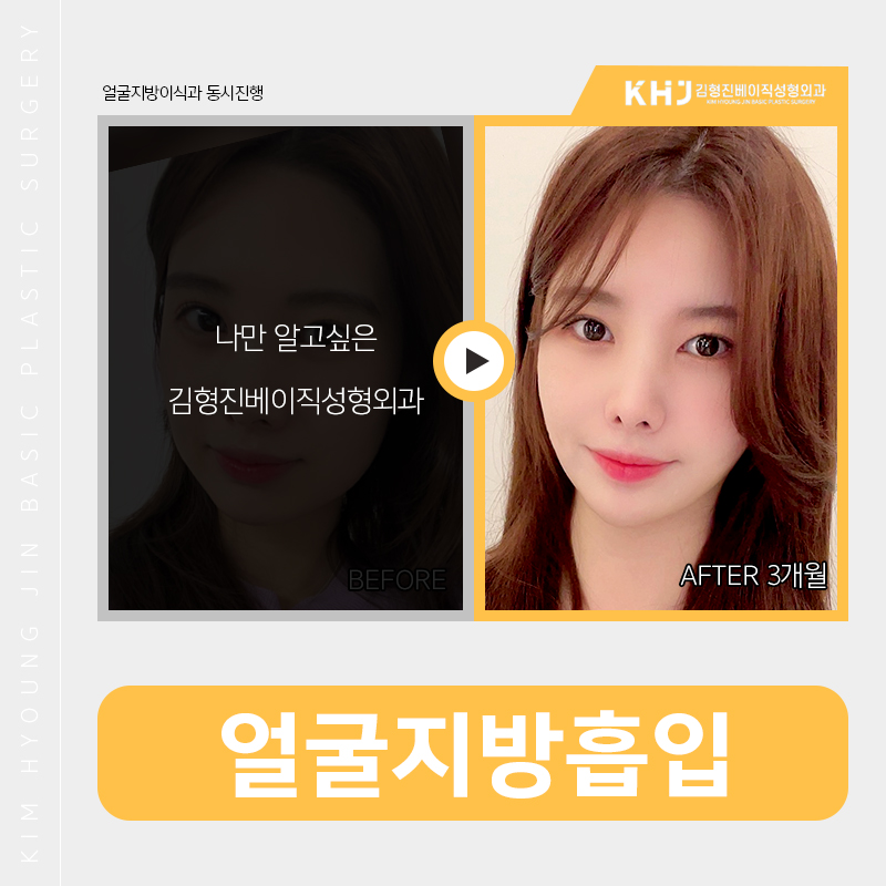 얼굴지방흡입전후 확실한 김형진베이직이죠? 관련 이미지 5