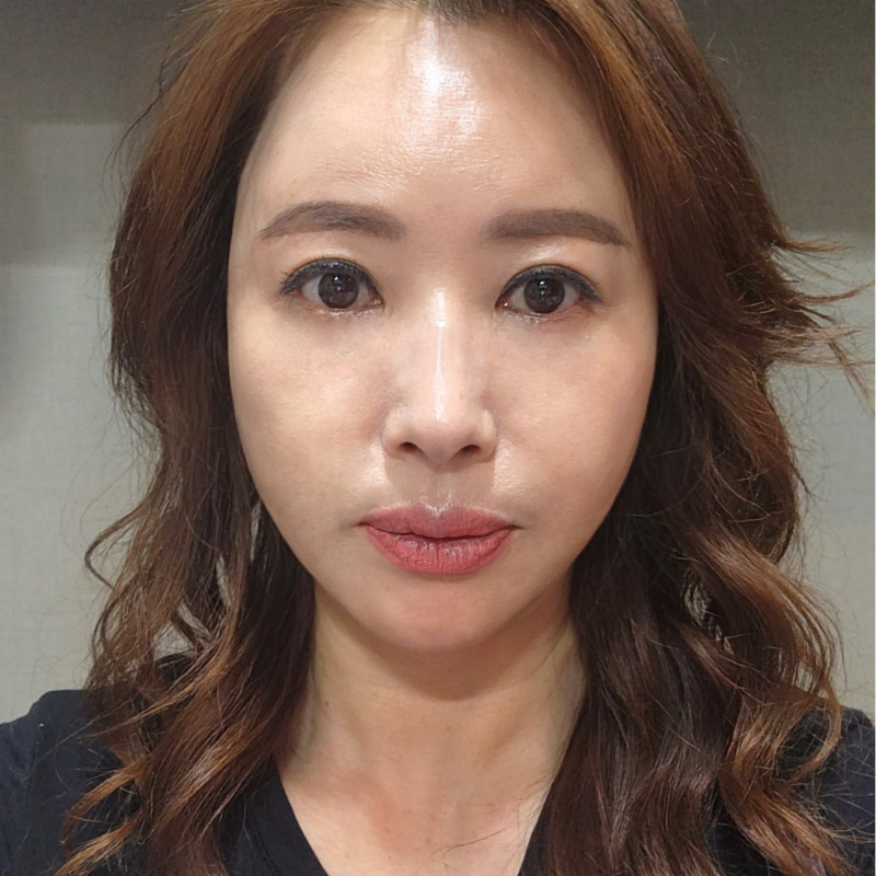 미니하안검전후 비교해보고 결정하세요! 관련 이미지 2