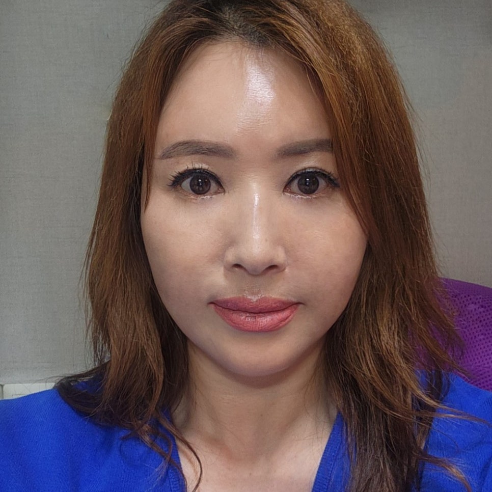 중년수술, 미니하안검후기 보고 결정하세요! 관련 이미지 2