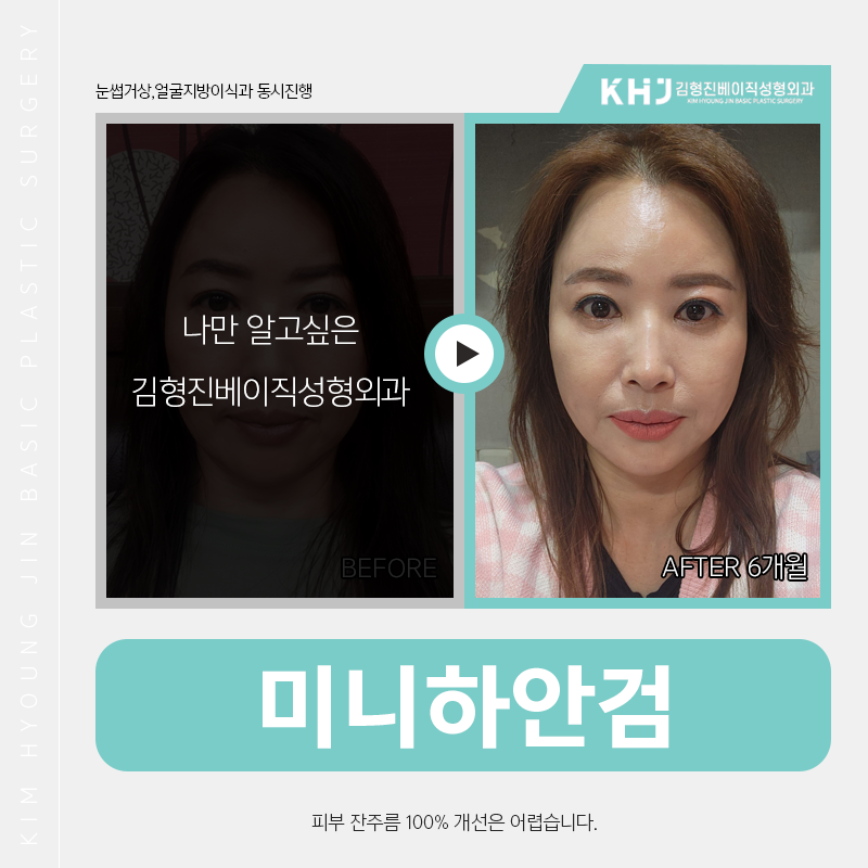 미니하안검효과 얼마나 좋냐면요 관련 이미지 5