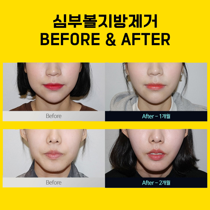 얼굴살없애는법 쉬운 길 두고 돌아가지 마세요! 관련 이미지 6