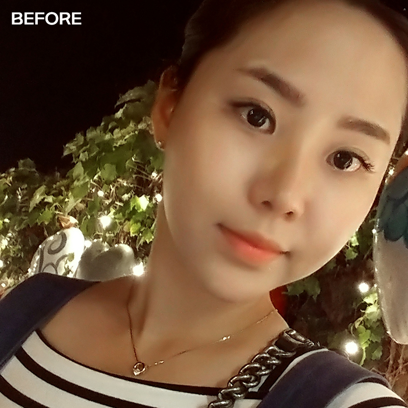 김형진베이직 얼굴지흡효과 좋다 좋아 관련 이미지 2