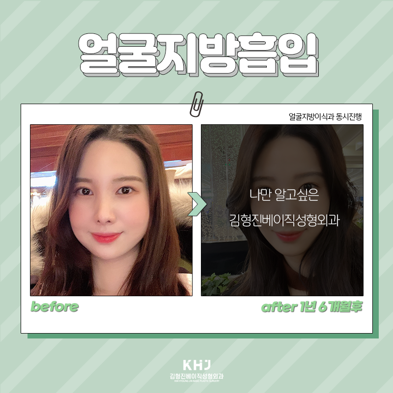 얼굴지방흡입비용 저렴한 곳보다는 잘하는 곳에서 하셔야죠 관련 이미지 5