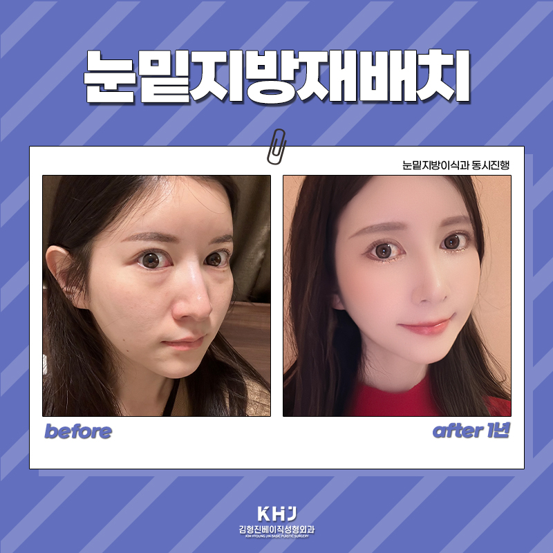 눈밑지방제거효과 확실하게 보고 싶다면 관련 이미지 5